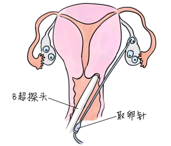 小儿退烧推拿手法 5种大连捐卵宝宝退烧按摩方法